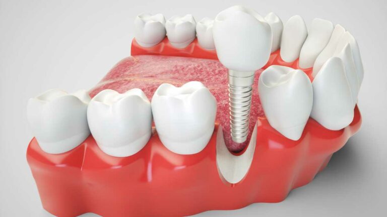 quanto custa para remover um implante dentário