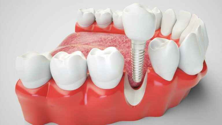 quanto custa para remover um implante dentário