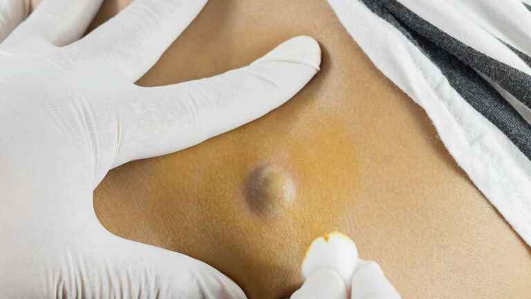 Como funciona o tratamento do cisto pilonidal