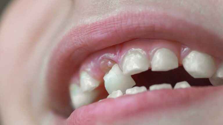 Dente de leite: Nascimento e queda