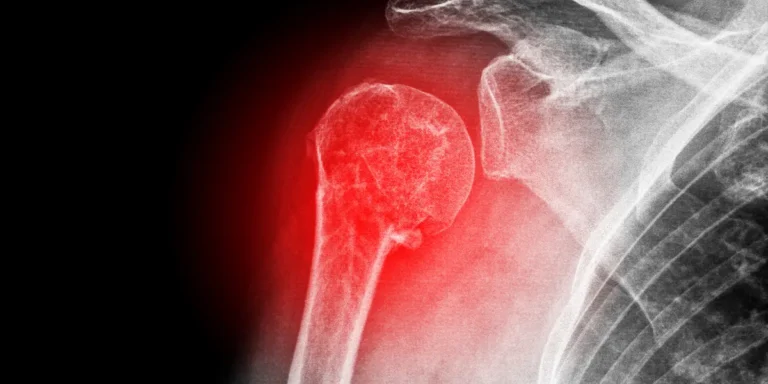 Fratura no ombro precisa de cirurgia